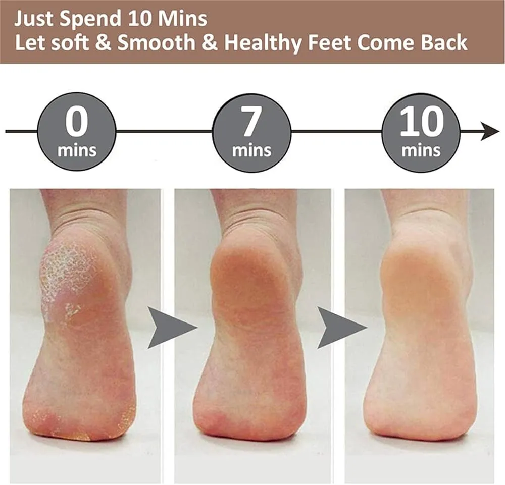 Electric Foot Callus Remover – Appareil Rechargeable pour Retirer la Peau Dure – Image 5